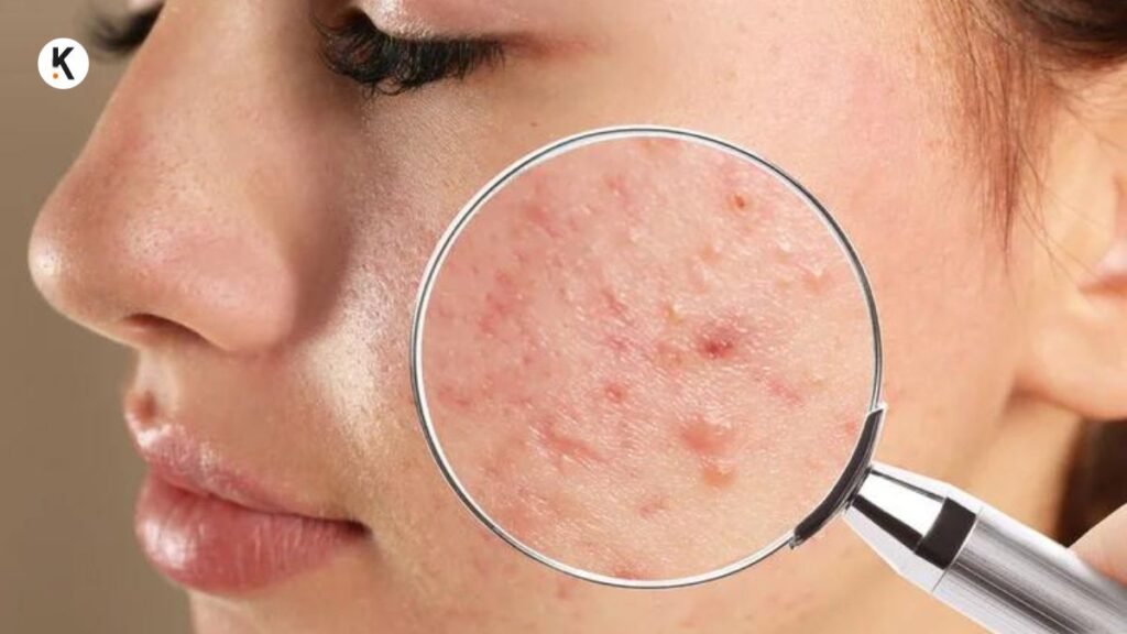 Acne skin क्या है?