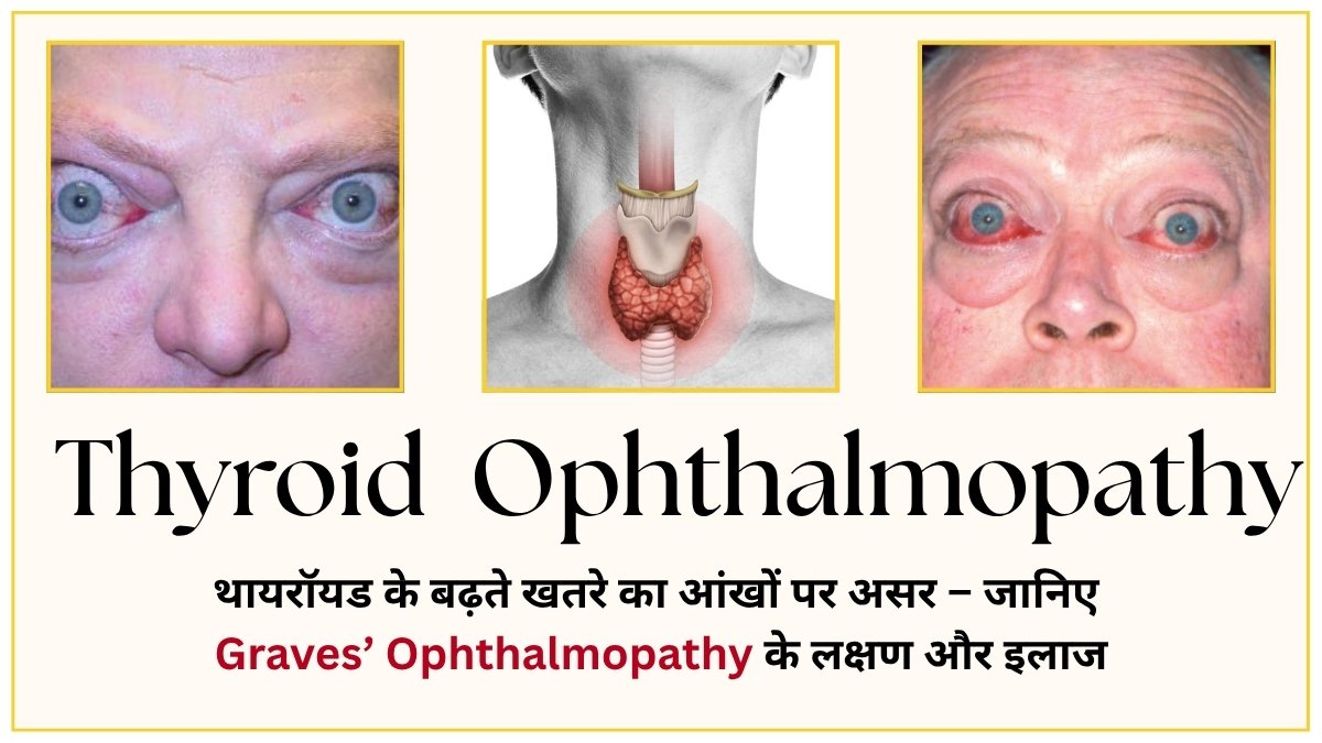 Ophthalmopathy